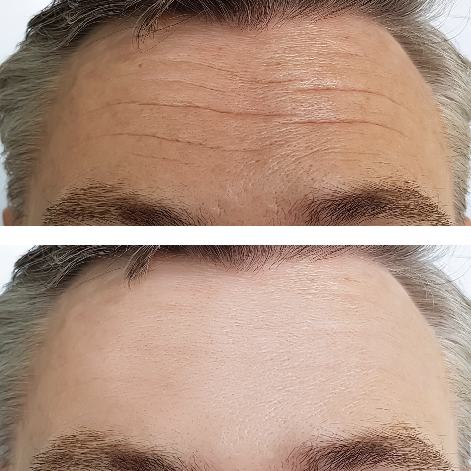 Anti-wrinkle demonstration before and after